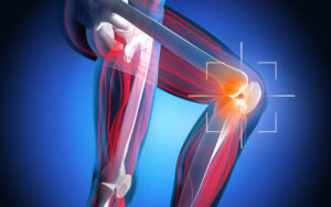 MPFL Repair vs. MPFL Reconstruction for Patellar Instability - Coach ...